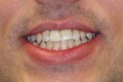 Implants after