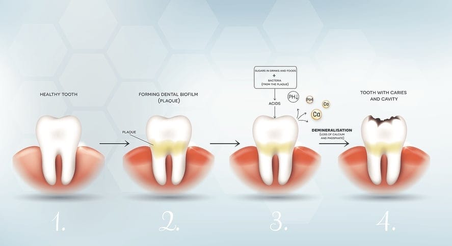 dental plaque on tooth dental plaque on tooth