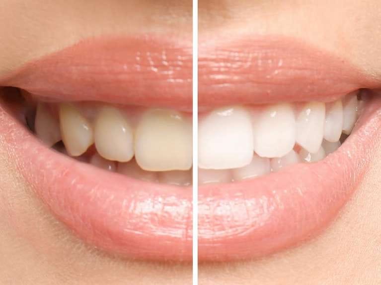 Zoom! In-Office Whitening in Pikesville, MD Zoom! In-Office Whitening in Pikesville, MD