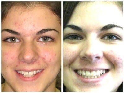 Before and after