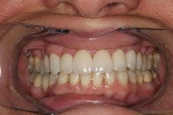 Veneers after