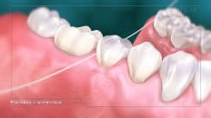 Bridge Versus An Implant 007