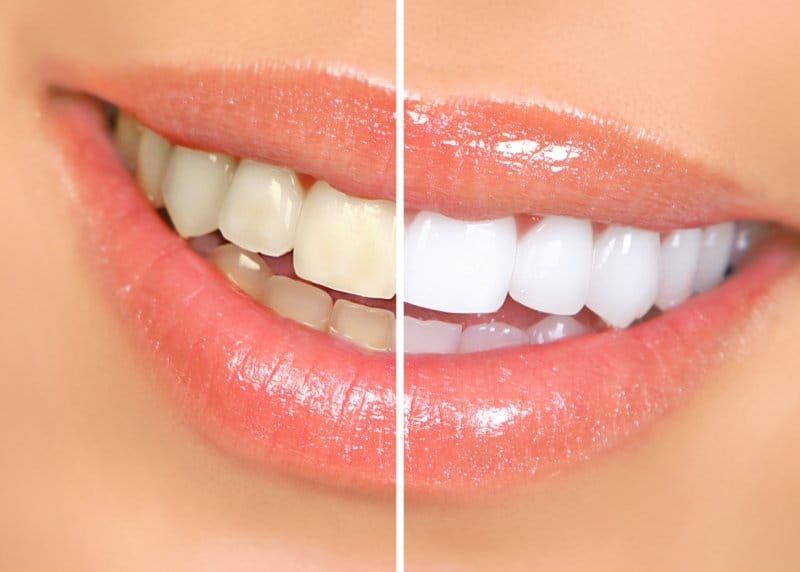 I'd Love to Get a Smile Makeover, but How Long Does It Take