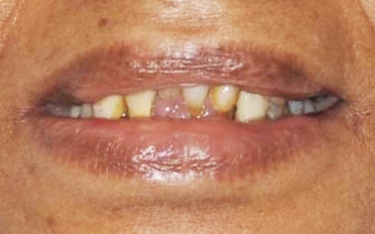 29. Patient KY (complete implant reconstruction upper and lower)_ Maxillary and mandibular hybrid denture prostheses Before