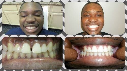 Before and after