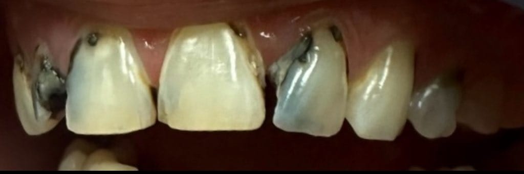 Bright Smiles Marble Falls Case 3 before