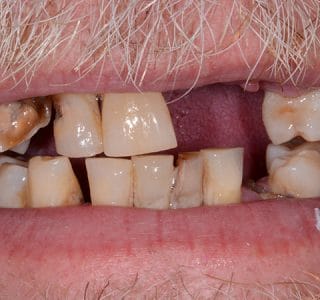 Dentures Before