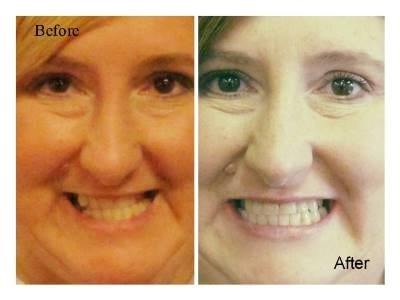Before and after