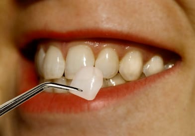 Porcelain Veneers