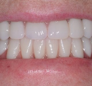 Dental Implants After