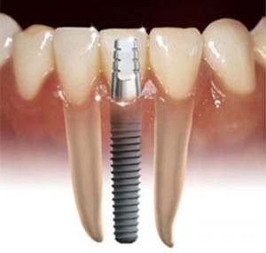 implant