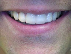 Veneers after