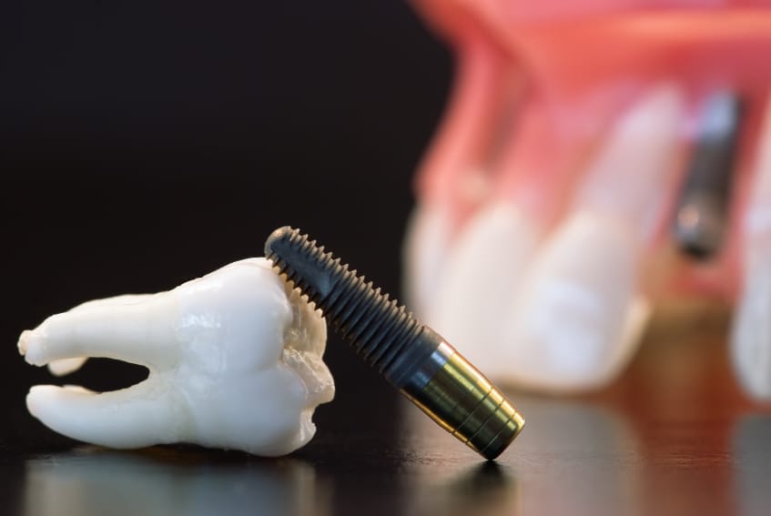 Dental Implant Dental Implant