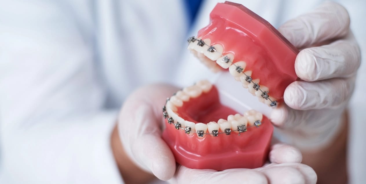 Close-up of a dentist holding a dental model with metal braces, wearing white gloves. Close-up of a dentist holding a dental model with metal braces, wearing white gloves.