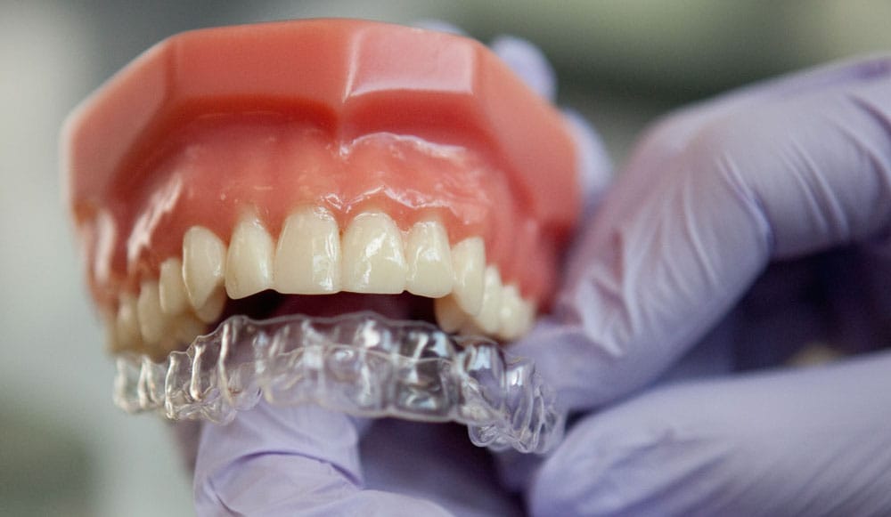 Clear braces for adults