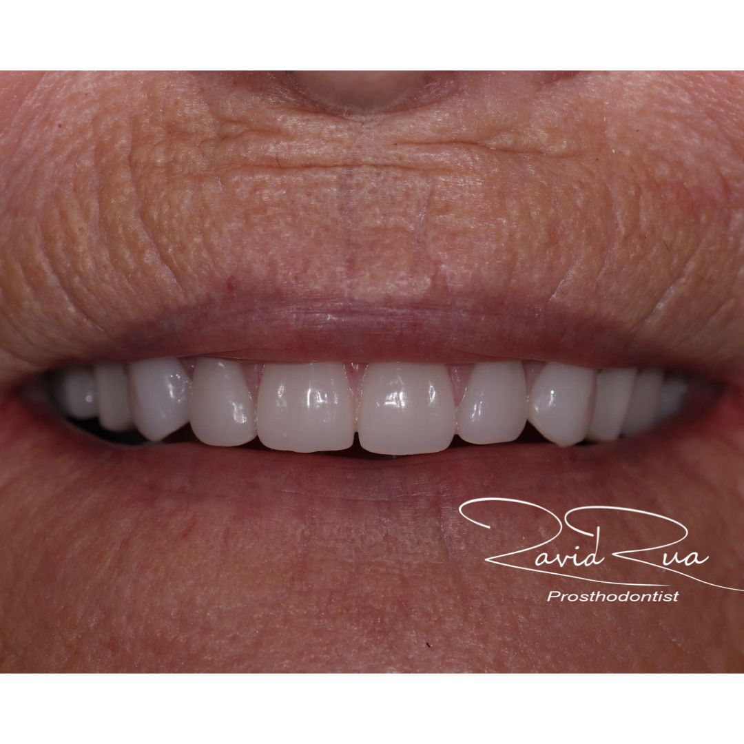TC Cape Coral Case 9.3 Top and Bottom implants/bar supported overdentures