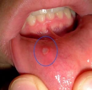 Oral Herpes