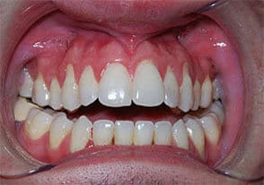 ballston smile gallery case-12-before