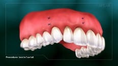 Connective Tissue Graft 003