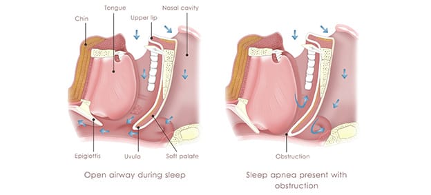 Sleep Apnea Treatment Sleep Apnea Treatment