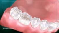 Cracked Tooth 001