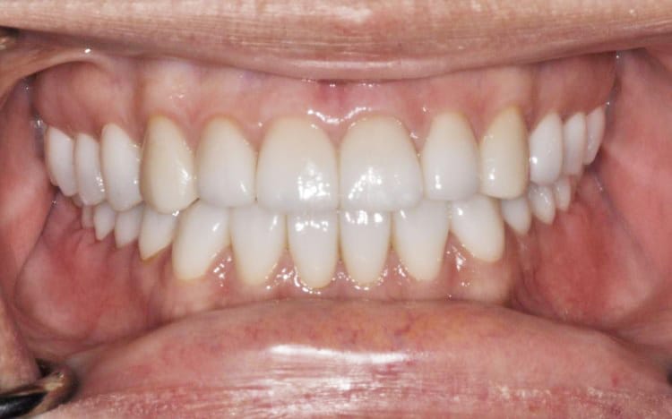 27. Patient MR (all 28 teeth)_ 14 upper porcelain crowns and 14 lower porcelain crowns After