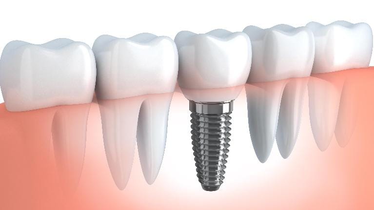 Dental Implant Dental Implant