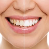 Teeth whitening