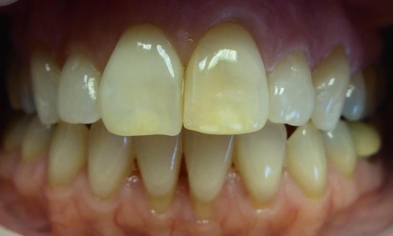 Grapevine Before Veneers 1