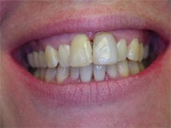 Veneers before