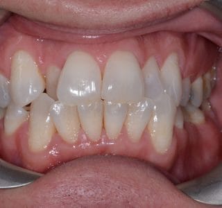 Dental Implants & Crowns Before