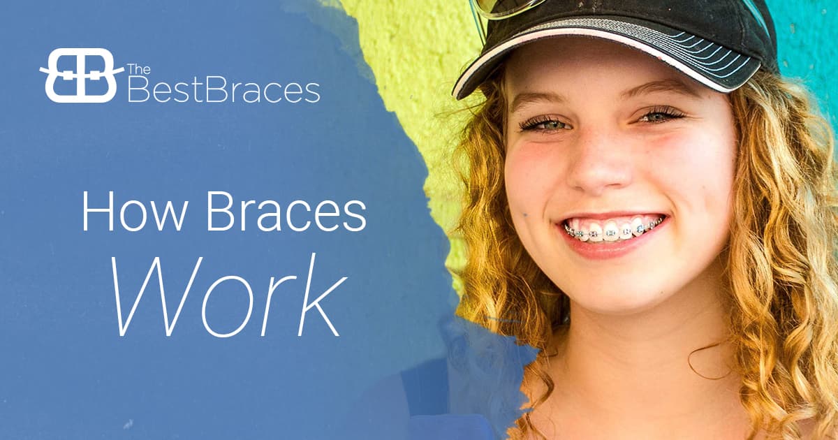 How Braces Work How Braces Work