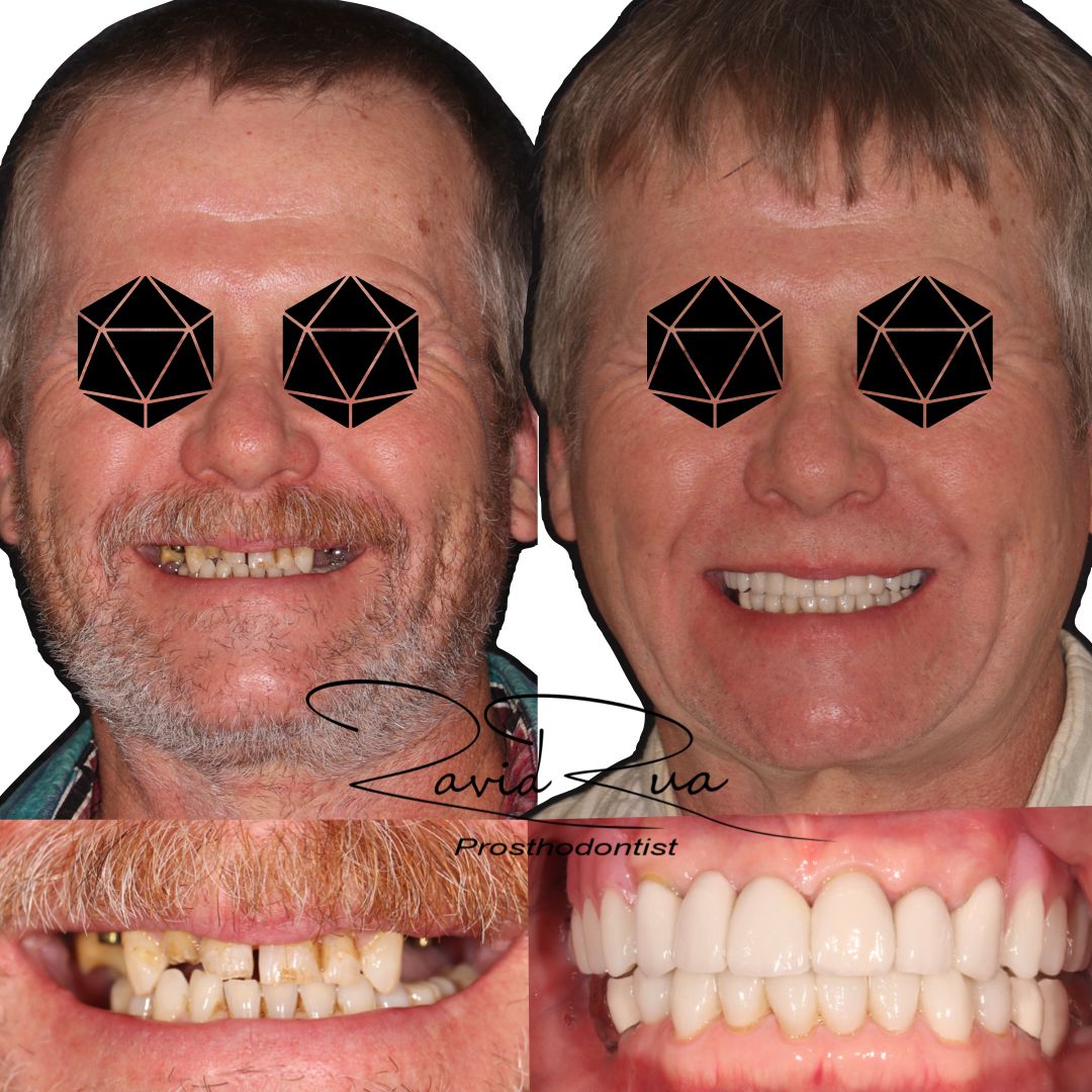 TC Cape Coral Case 8 Full mouth rehab with crowns, implants and a top partial