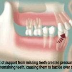 How important are dental implants?