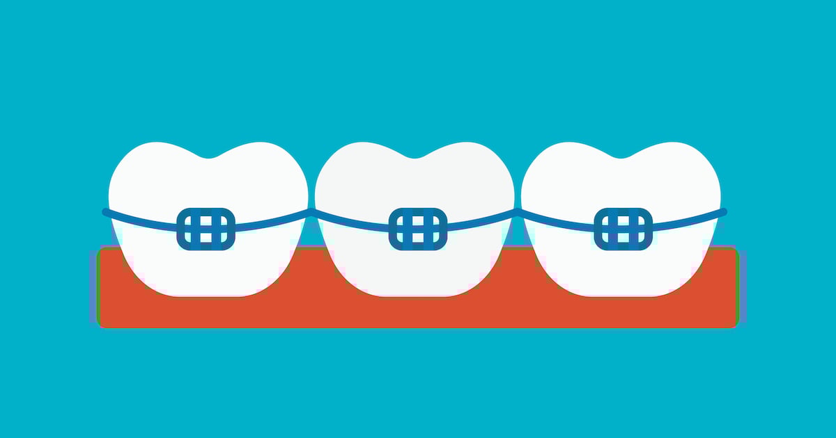 How to Take Care of Braces for Kids | Braces Northern Virginia