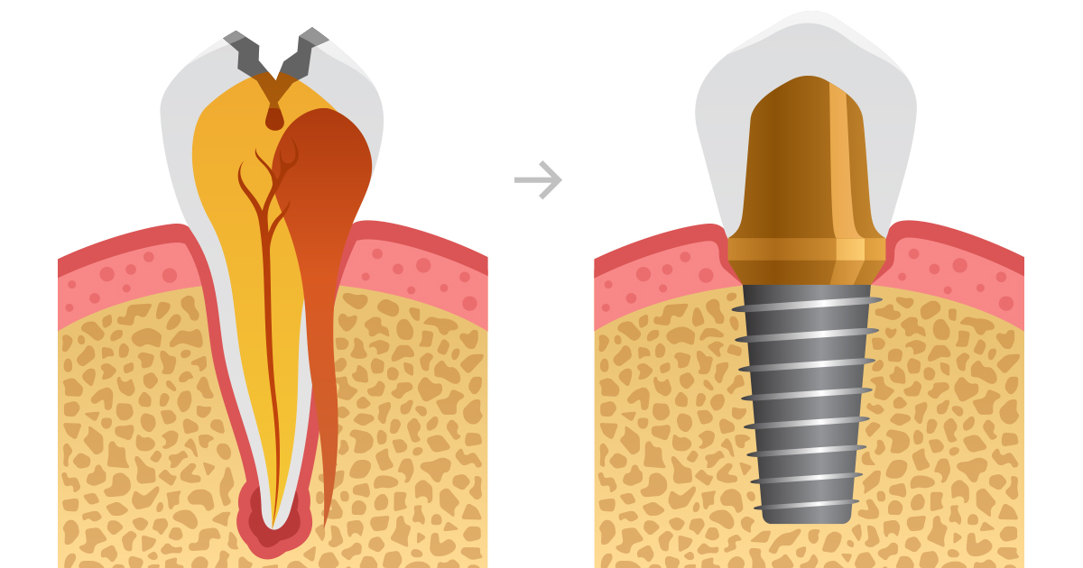 Are You Ready for Affordable Dental Implants? Dental Implants Florida