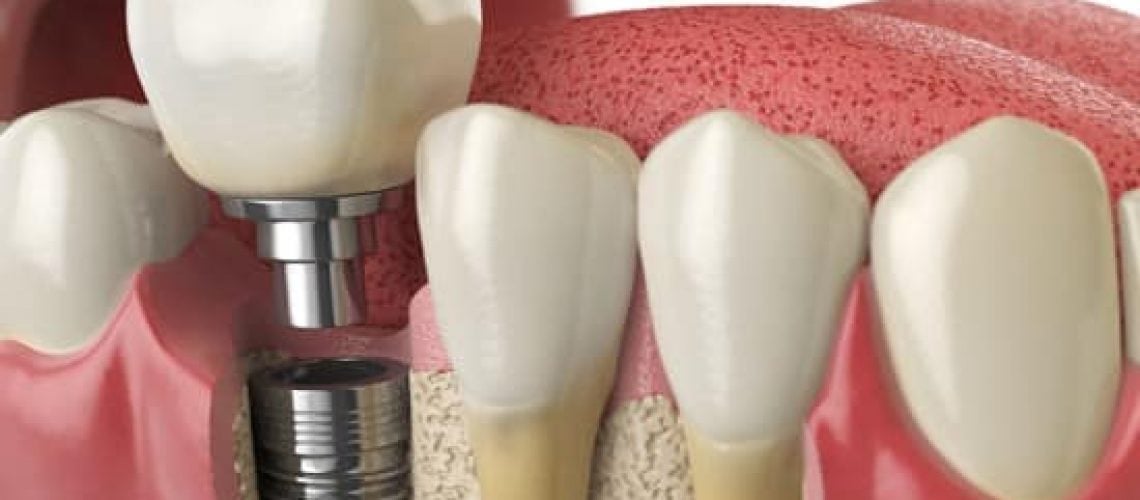 Alsbury Dental Implants Candidate Alsbury Dental Implants Candidate