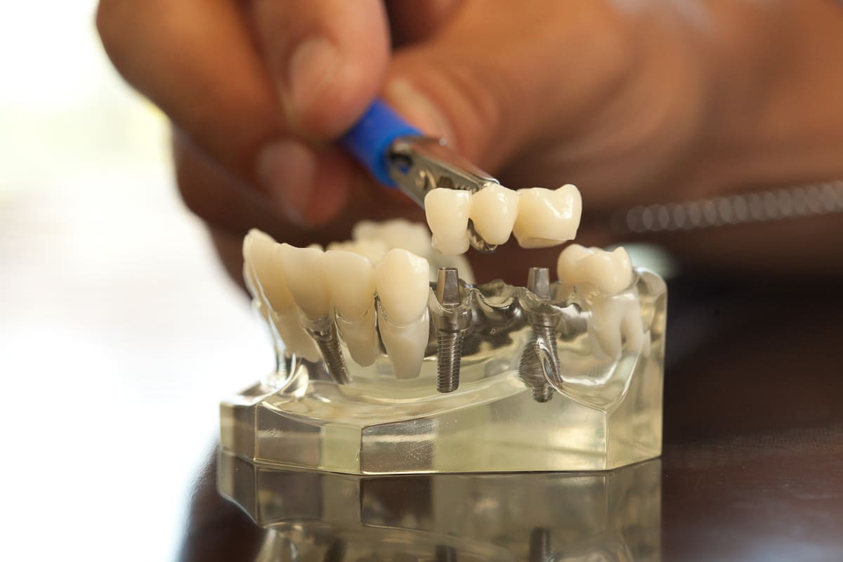 9 Warning Signs You May Need Dental Implants