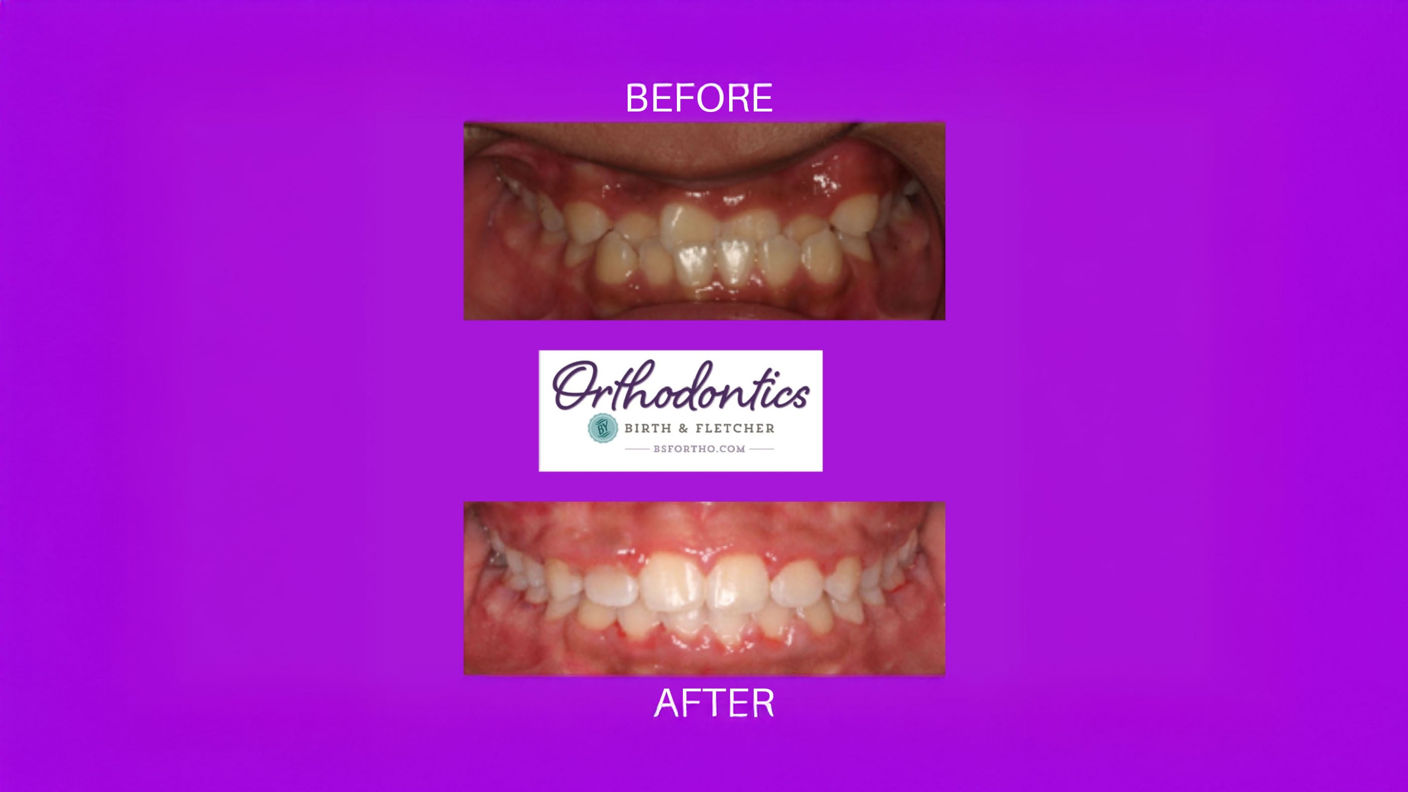 BF Ortho Blog before and After
